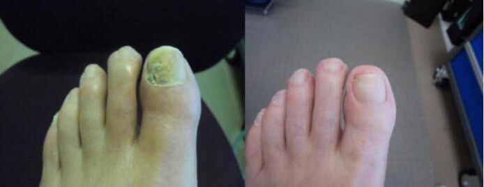 Photos de pieds avant et après l'utilisation de la crème Zenidol