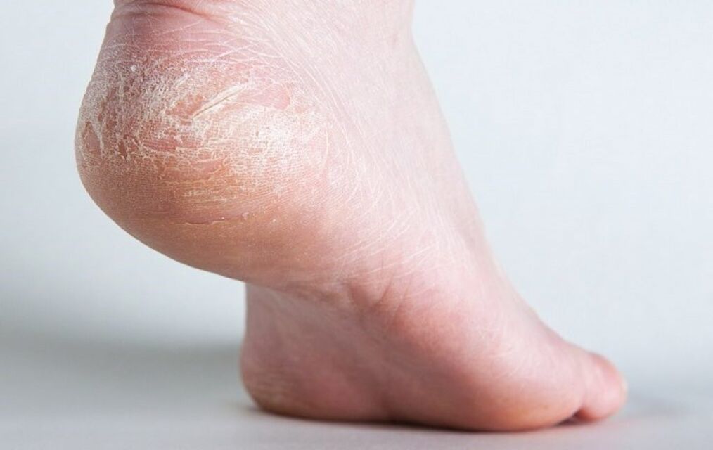 champignon de la peau des pieds