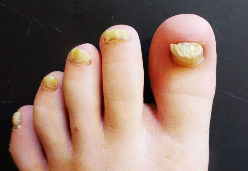 Aspect inesthétique des ongles des pieds affectés par des champignons. 