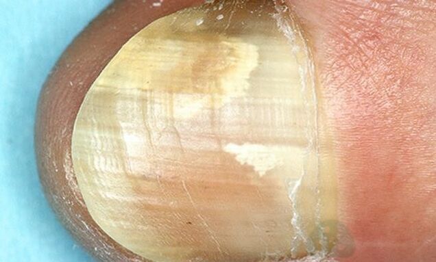 traiter la mycose des ongles avec des préparations internes